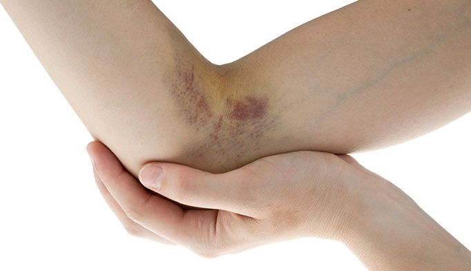 How To Get Rid Of Bruises (Ultimate Guide)